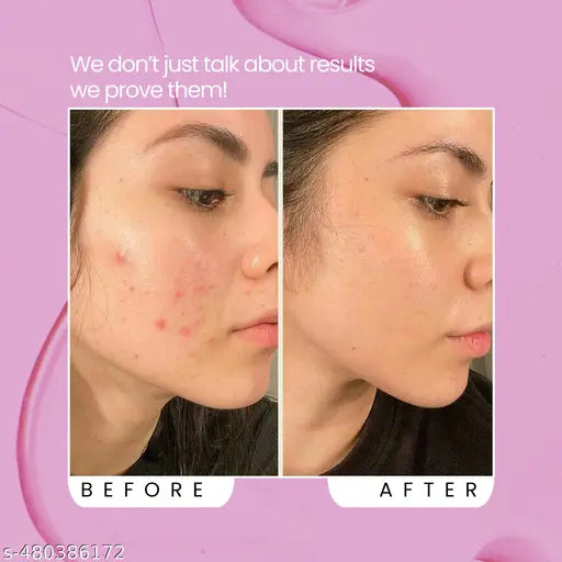 Foxtale Niacinamide Clarify Serum (Reduce Acne & Dark post + Brighten up skin tone)