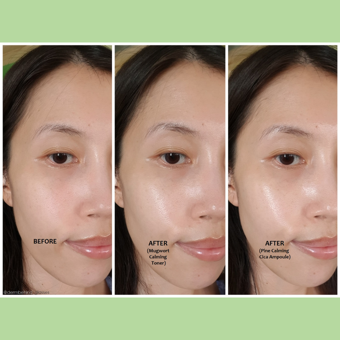 Orien Soothing Spray Toner for Spotless Skin - Removes Acne, Fades Dark Spots, Reveals Glow