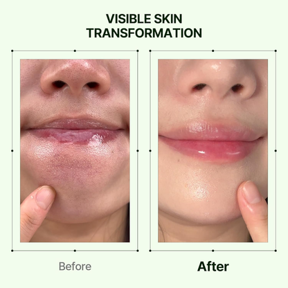 Orien Soothing Spray Toner for Spotless Skin - Removes Acne, Fades Dark Spots, Reveals Glow