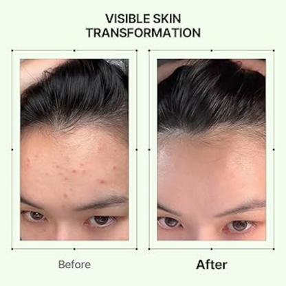 Orien Soothing Spray Toner for Spotless Skin - Removes Acne, Fades Dark Spots, Reveals Glow