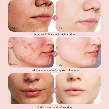 Foxtale Niacinamide Clarify Serum (Reduce Acne & Dark post + Brighten up skin tone)