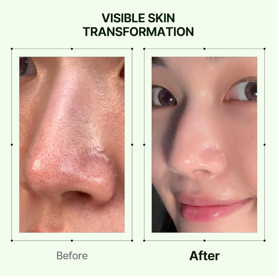 Orien Soothing Spray Toner for Spotless Skin - Removes Acne, Fades Dark Spots, Reveals Glow