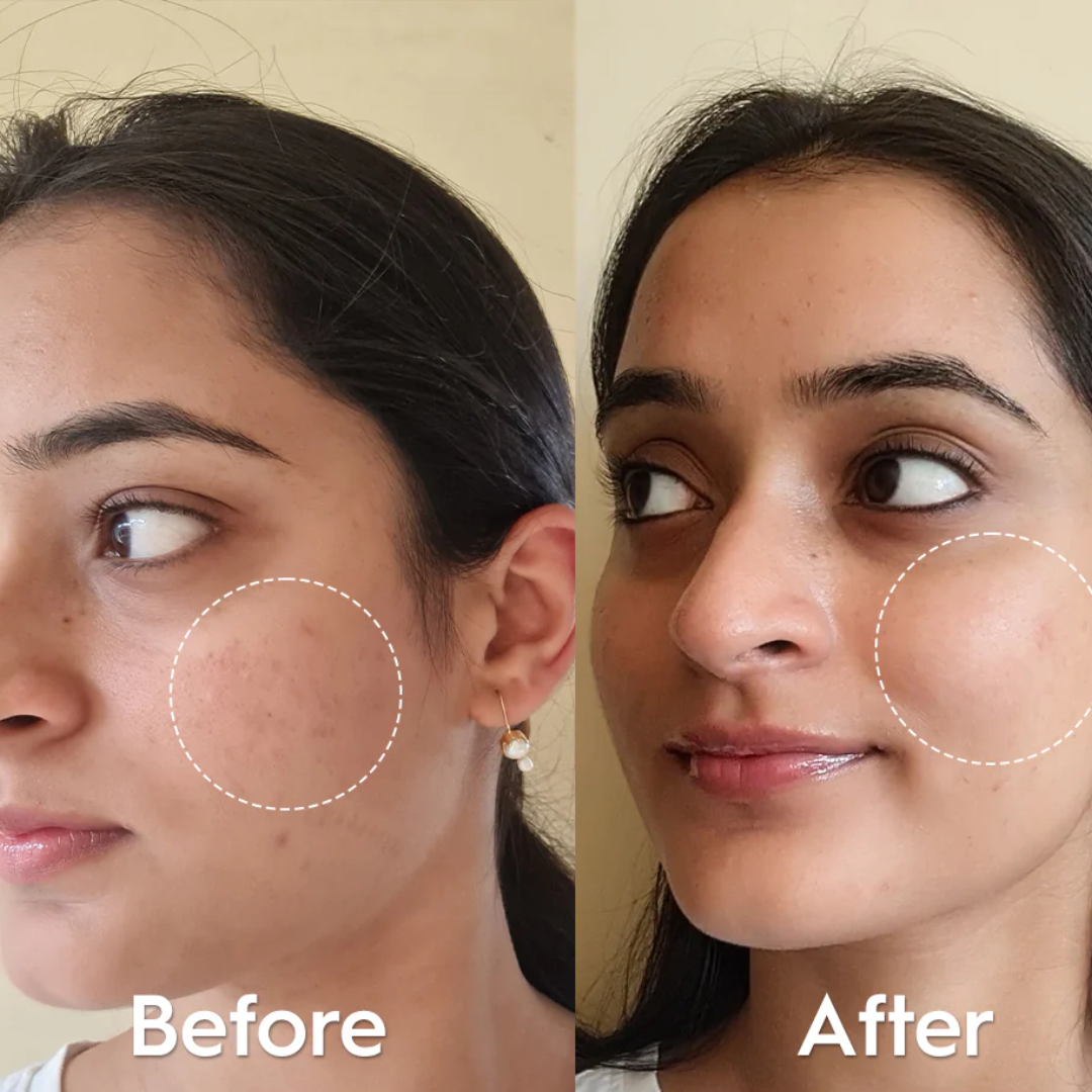 Foxtale Niacinamide Clarify Serum (Reduce Acne & Dark post + Brighten up skin tone)