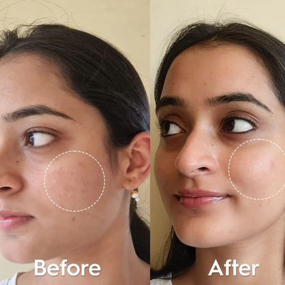 Foxtale Niacinamide Clarify Serum (Reduce Acne & Dark post + Brighten up skin tone)