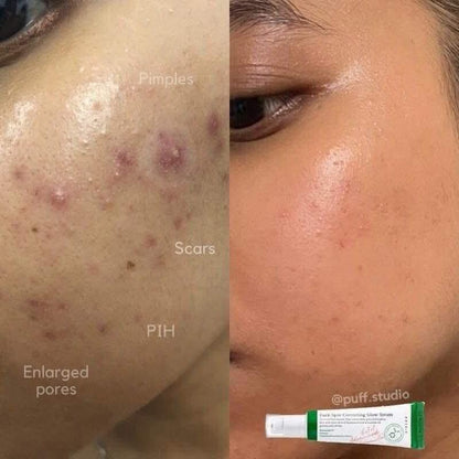 Axis-y dark spot correcting serum