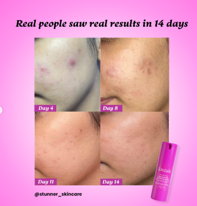 Foxtale Niacinamide Clarify Serum (Reduce Acne & Dark post + Brighten up skin tone)