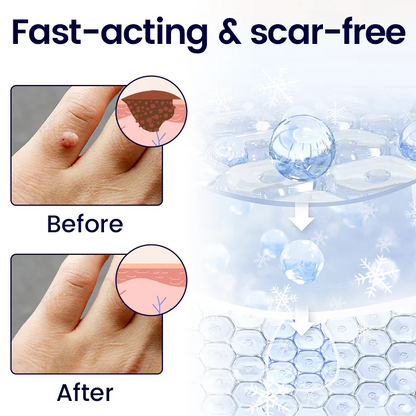 Timilk Wart & Mole Removal Spray | Painless, Fast Acting & Scar Free Skin | Best for Warts, Moles & Skin tags